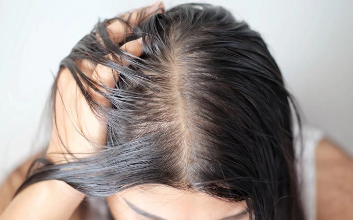 Oily scalp and hair fall in summer