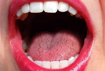 Dry mouth as health warning sign